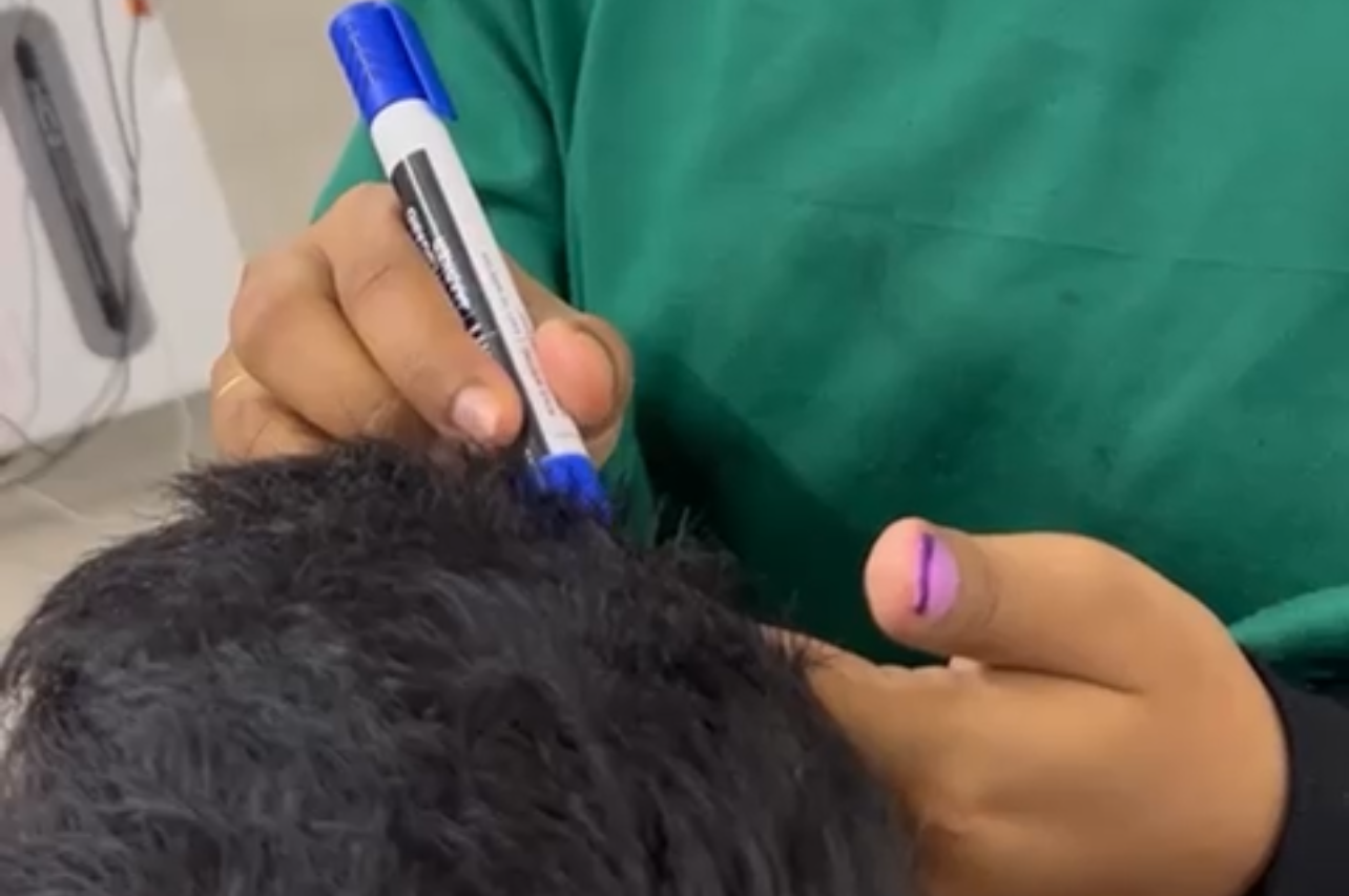 PRP or GFC scalp treatment at Transformance