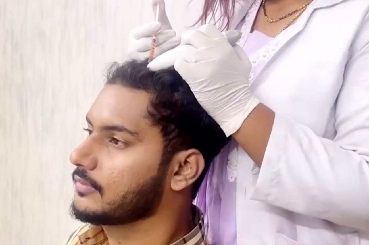 Scalp treatment procedure at Transformance Hyderabad
