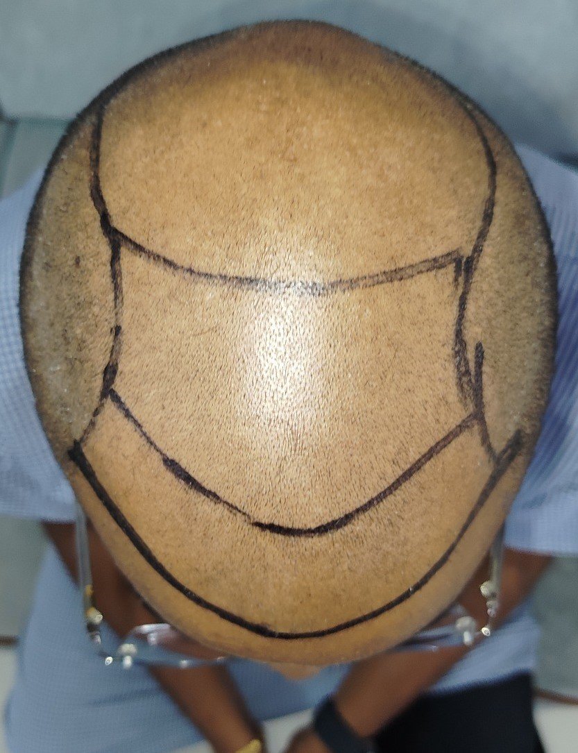 Transformance hair transplantation procedure
