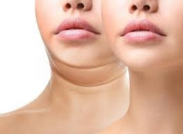 Double Chin Treatment Hyderabad