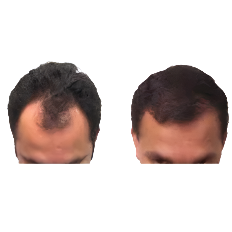 Top Hair Transplantation in Hyderabad
