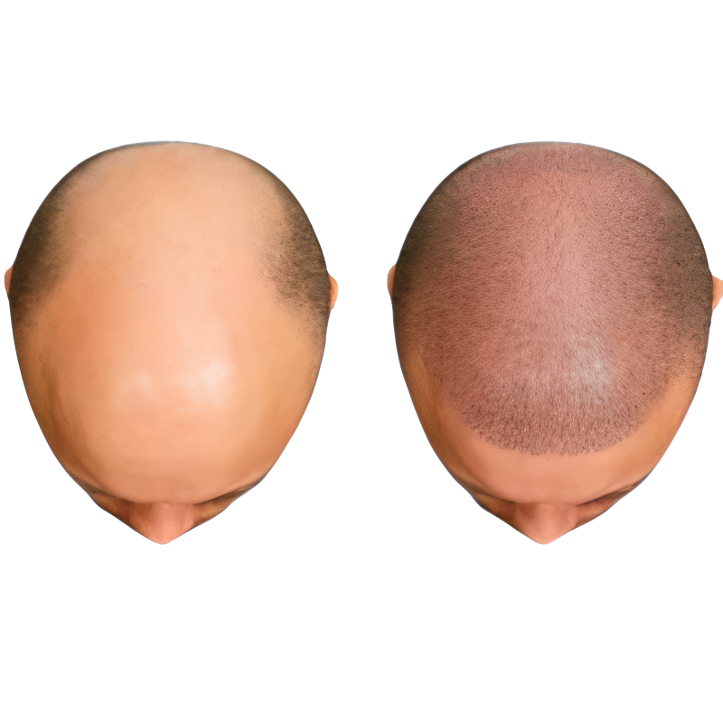 Top Hair Transplantation in Hyderabad