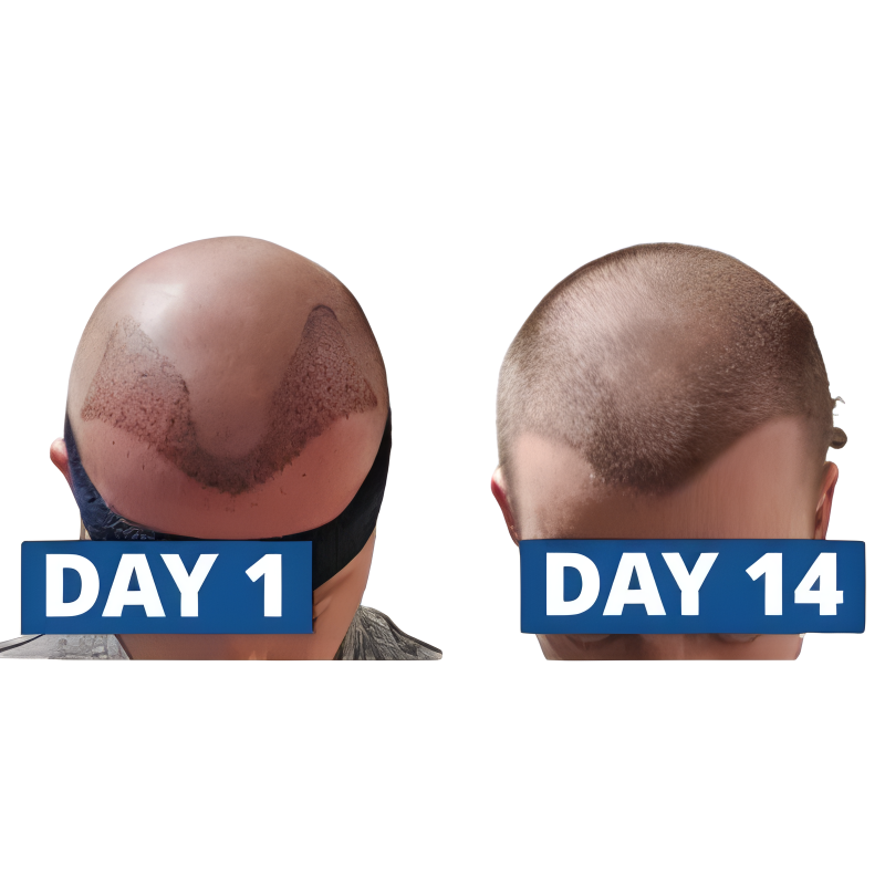 Top Hair Transplantation in Hyderabad