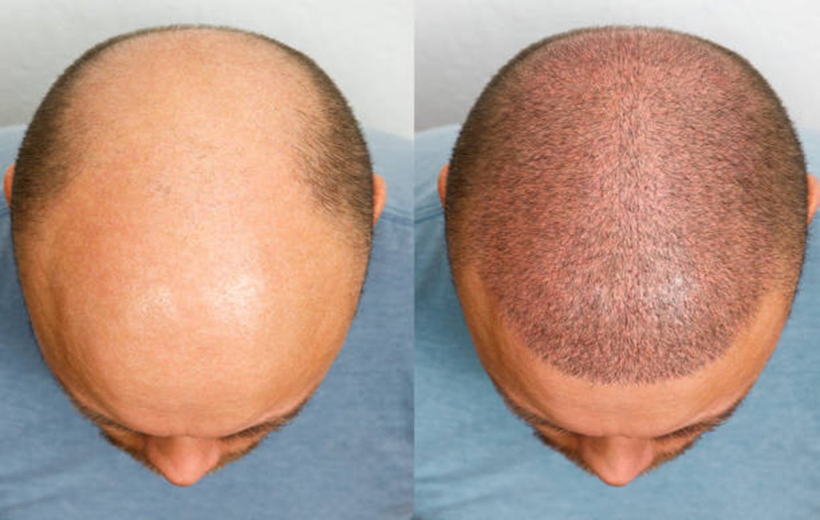 Hair density progress six weeks after treatment at Transformance Hyderabad