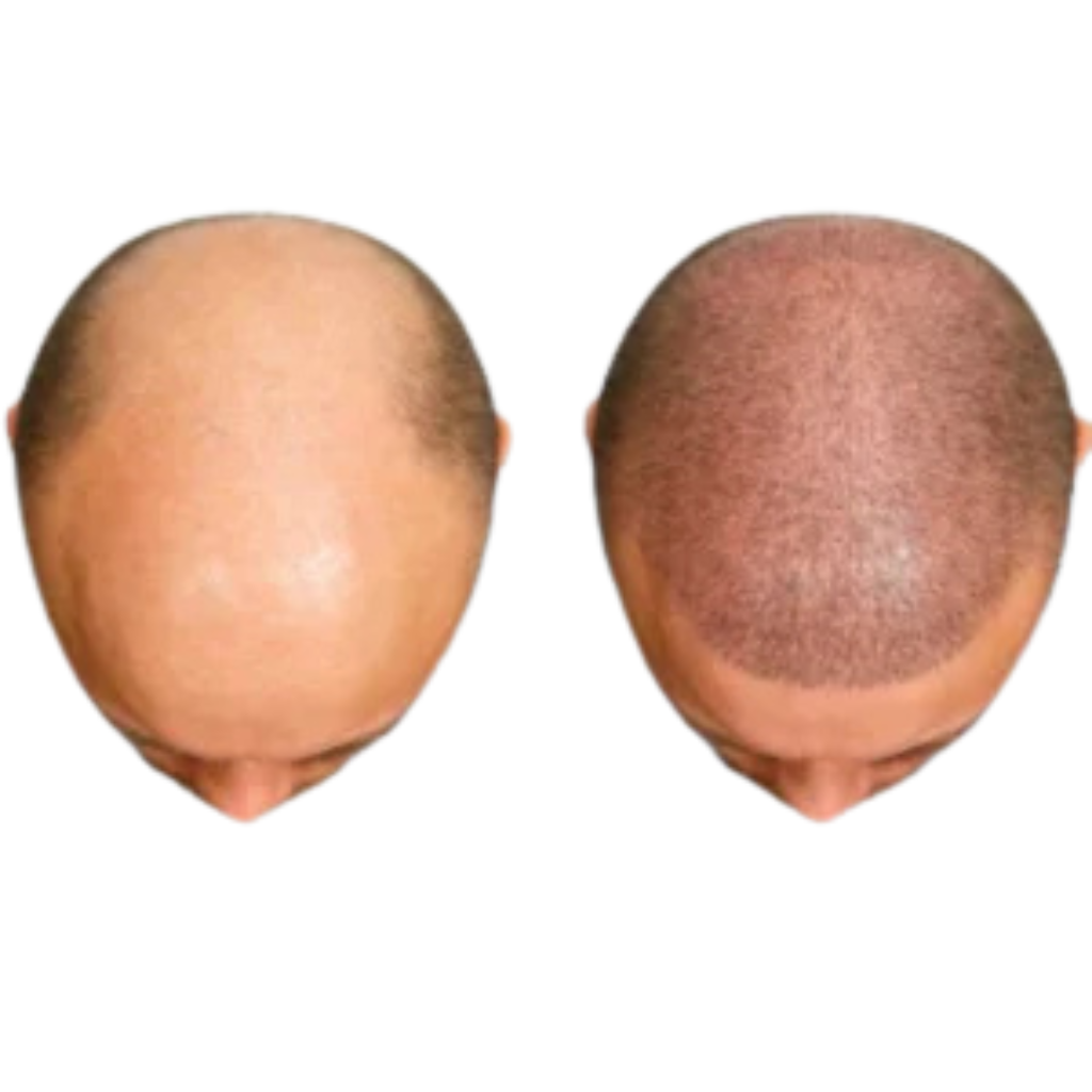 Scalp Micropigmentation in Hyderabad - hair density result at Transformance