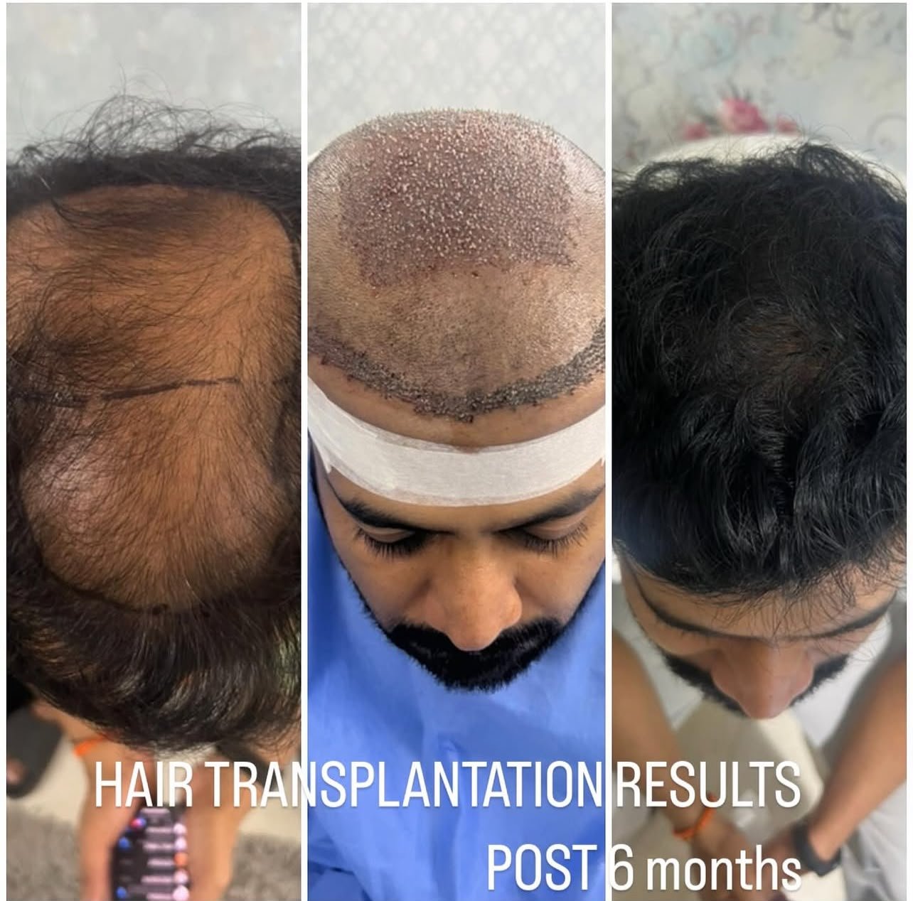 Hair transplant result Transformance Hyderabad