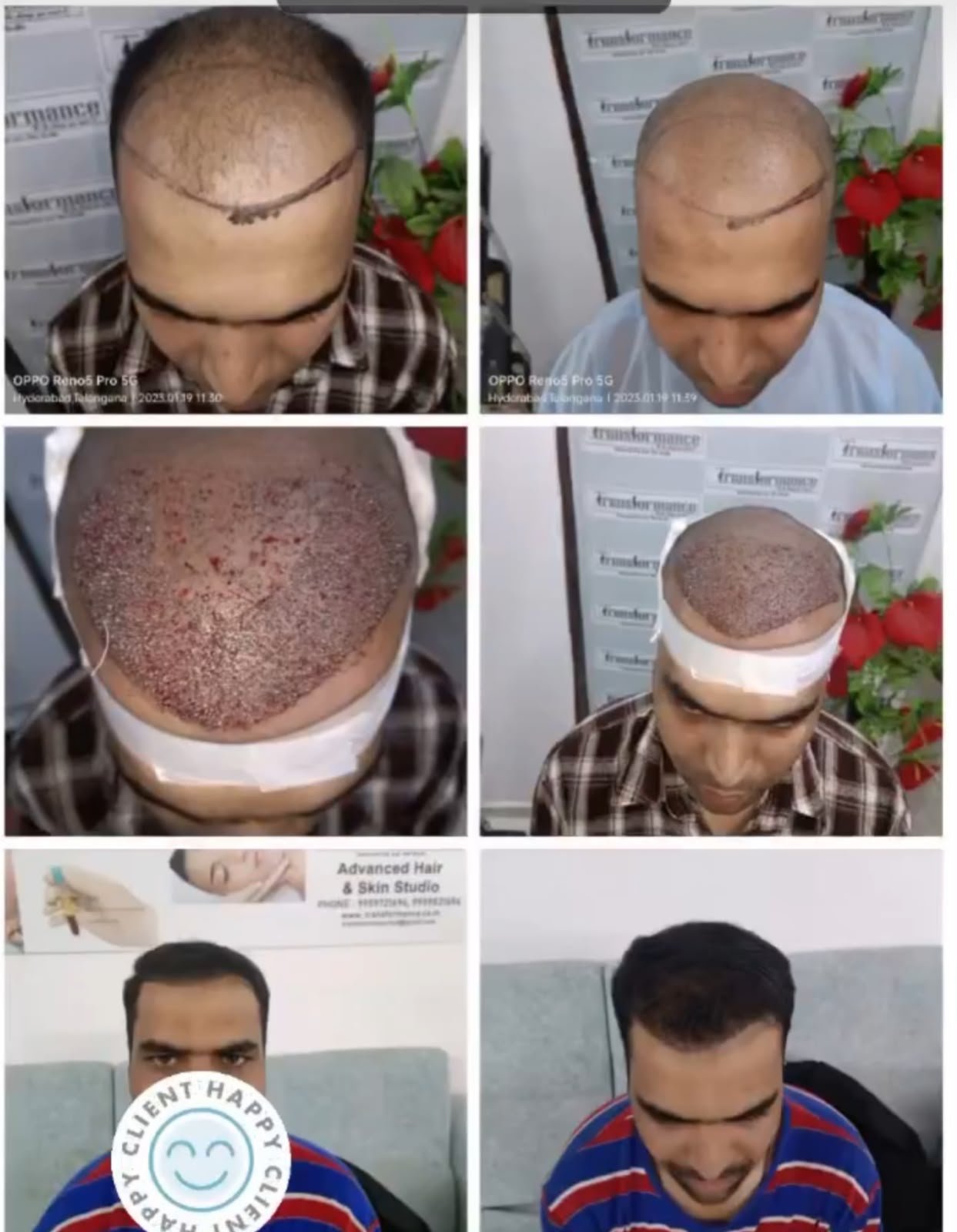 Hair restoration result Hyderabad