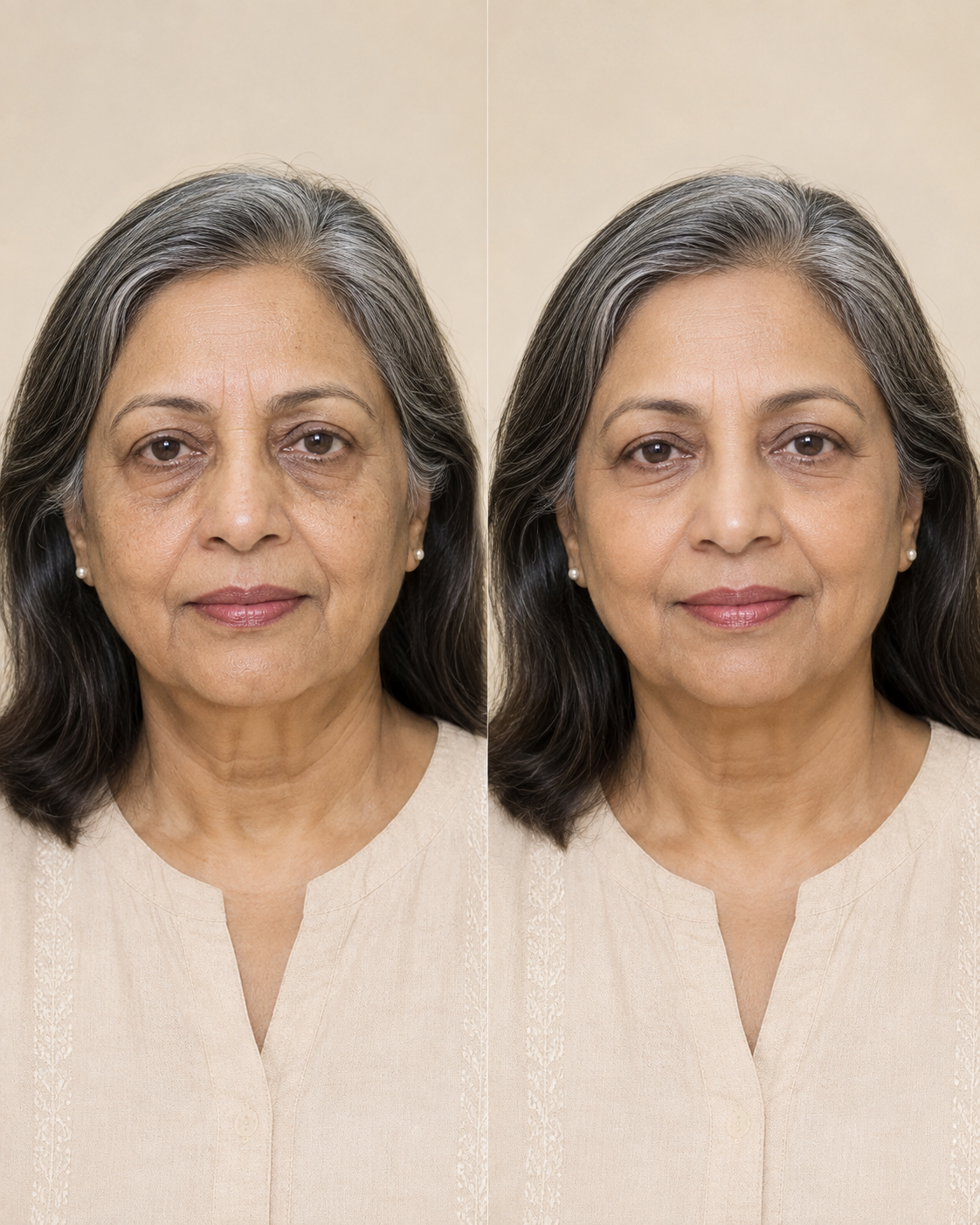 Anti Ageing Treatment in Hyderabad - illustrative facial rejuvenation before and after