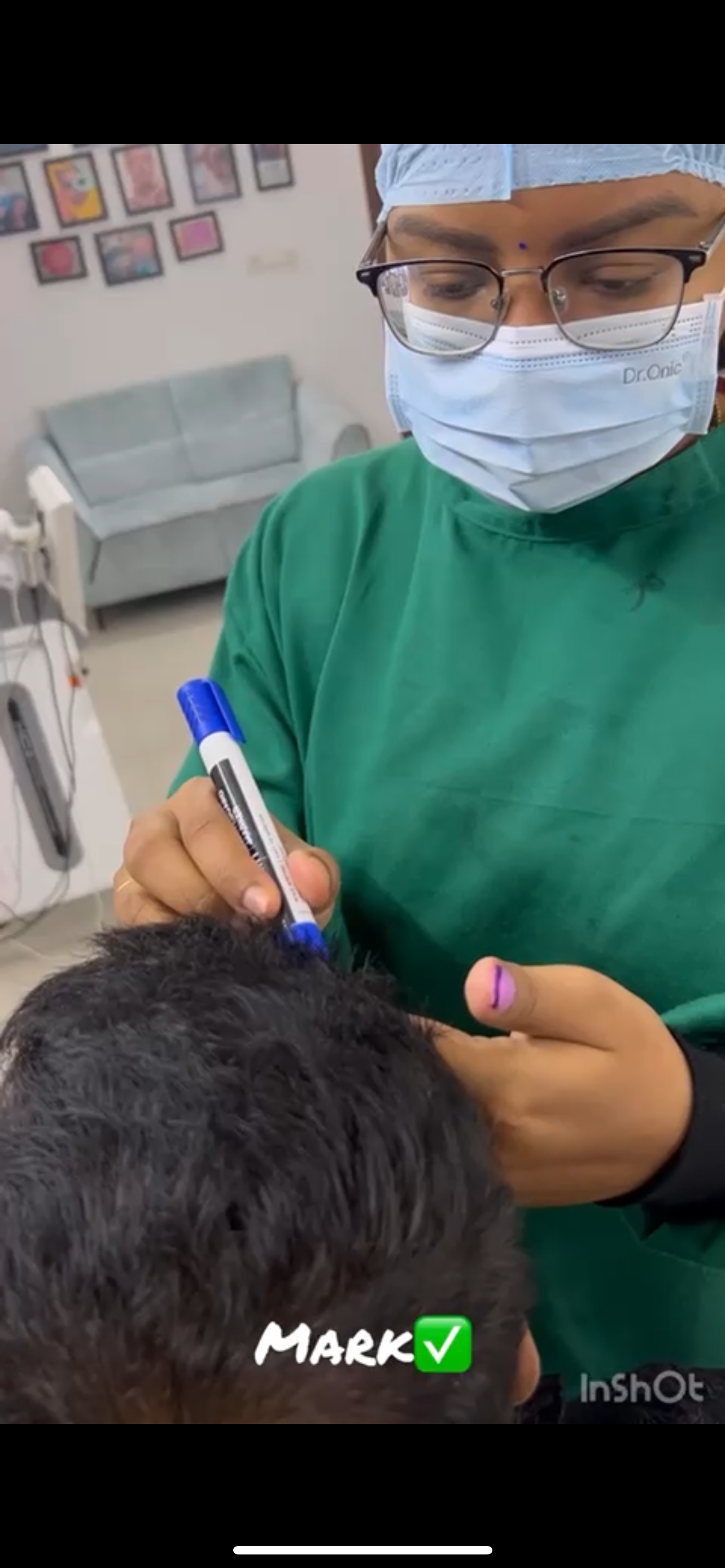 Hairline planning for hair transplant cost estimate in Hyderabad